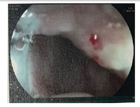 Figure 1 From Treatment Of Jejunal Angiodysplasia By Video Assisted