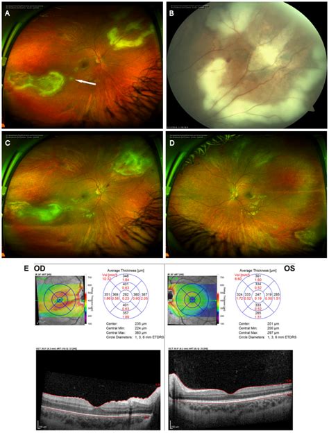 Progression Despite Treatment A Optos Ultra Widefield Photography Of