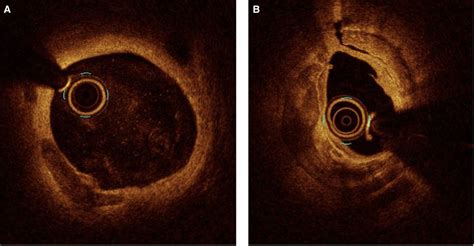 Calcium Modification Techniques In Complex Percutaneous Coronary