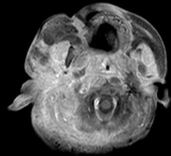 Understanding Kaposiform Hemangioendothelioma