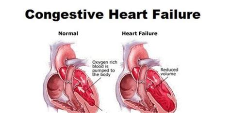 Congestive Heart Failure | New Life Ticket