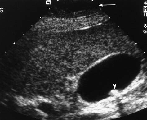 Gallbladder Stones Imaging And Intervention Radiographics