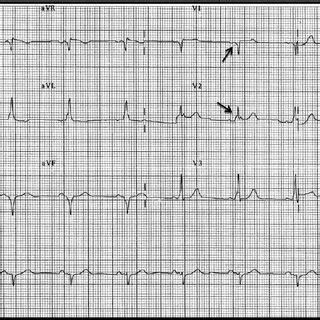 Panel A Shows The Baseline Electrocardiogram And Intracardiac