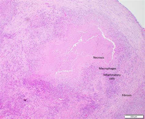 Caseating Granuloma Histology