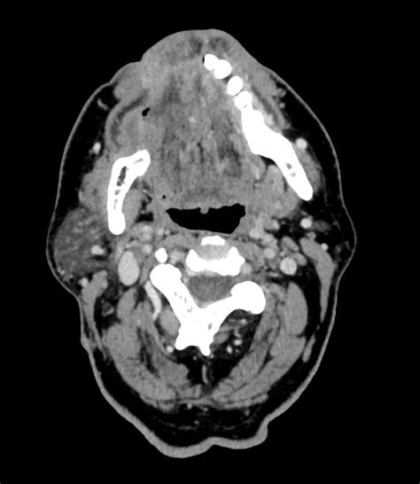 Mandibular Reconstruction Neuro Case Studies Ctisus Ct Scanning