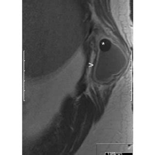 A Sagittal T1 Weighted Turbo Spin Echo MR Image Shows A Cystic