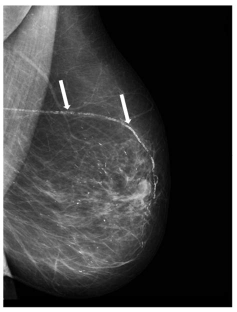 Biomedicines Free Full Text Relationship Between Arterial Calcifications On Mammograms And