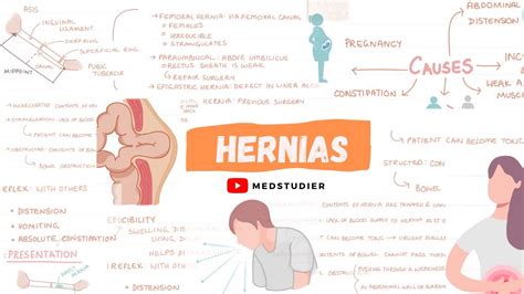 What Are Hernias Direct And Indirect Medstudier Youtube