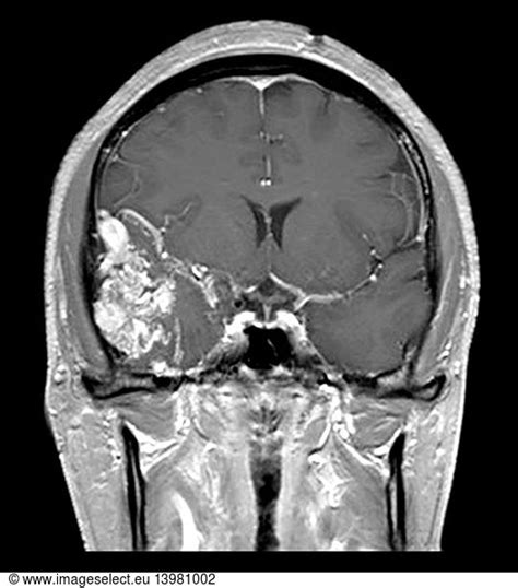 Temporal Lobe AVM on MRI Temporal Lobe AVM on MRI,abnormal,abnormality ...