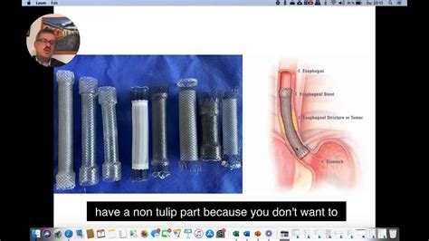 How To Place A Self Expanding Metal Stent Sems Into The Esophagus