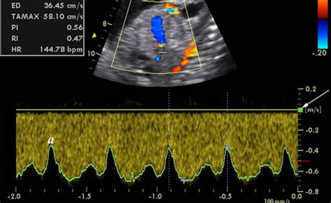 Diretrizes Pr Ticas Da Isuog Uso Doppler Em Obstetr Cia