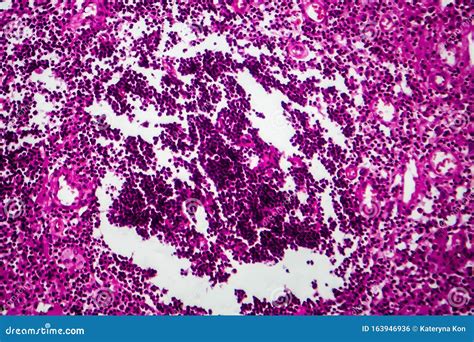 Bladder Cancer, Light Micrograph Stock Photo - Image of medical ...