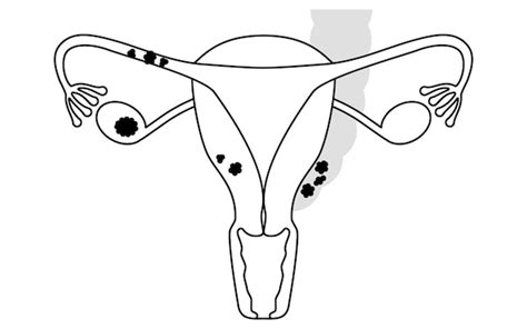 Premium Vector Diagrammatic Illustration Of Stage Ii Ovarian Cancer