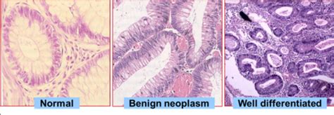 Cancer Biology Flashcards Quizlet