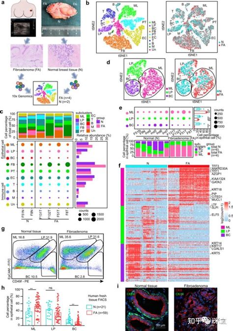 Nature Communications｜乳腺纤维腺瘤新靶点！单细胞测序揭示女性乳腺纤维腺瘤的独特的上皮细胞组成和治疗靶点 知乎