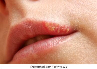 Case Pyogenic Granuloma On Lower Lip Stockfoto 1646473009 Shutterstock