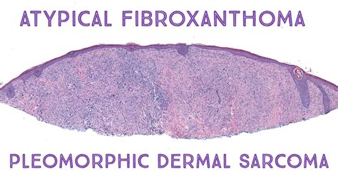 Atypical Fibroxanthoma And Pleomorphic Dermal Sarcoma Oregon Case 2