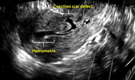 Transvaginal Ultrasound Examination Showing A C Section Scar Defect