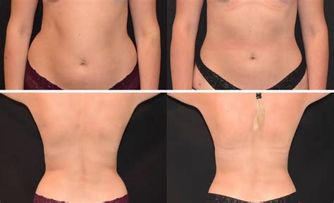 Back Fat Liposuction Before And After