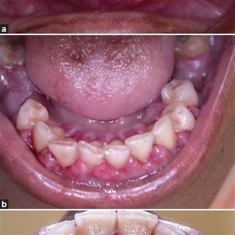 Frontal View Of The Increase In The Gingival Overgrowth 3 Weeks After