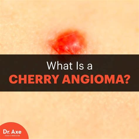 Cherry Angioma Risk Factors, Symptoms & Natural Treatments (DrAxe.com) | Cherry angioma, Natural ...