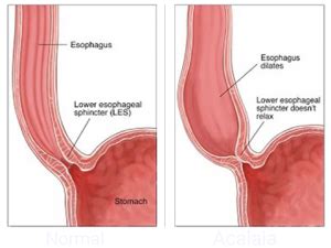 Achalasia Treatment At The Heartburn Center With Nwmc Tucson