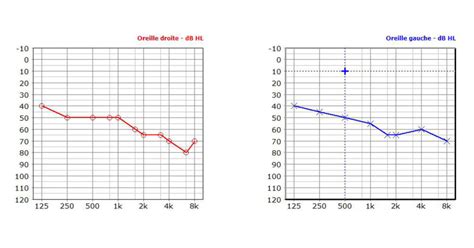 Comment Lire Un Audiogramme Correction Auditive Hert