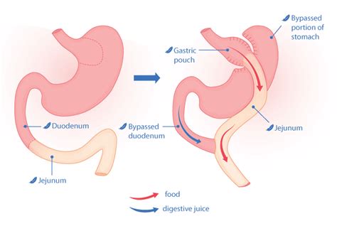 Gastric Bypass (RNY) | Go Light Bariatrics