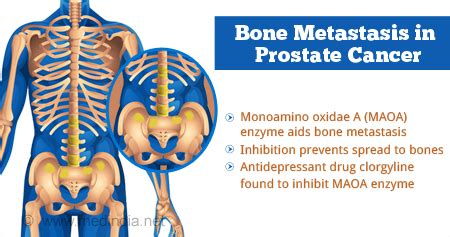 Health Tip on New Method that Prevents Bone Metastasis in Prostate Cancer Patients - Health Tips