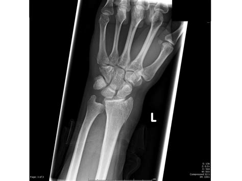 Distal Radial Fracture