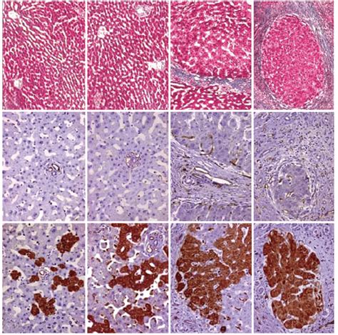 Liver Fibrosis A Angiogenesis B And Tsp 1 Expression C In The