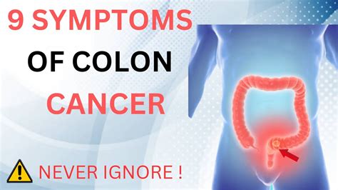 Colon Cancer Symptoms 9 Warning Signs Of Colon Cancer Colon Cancer Youtube