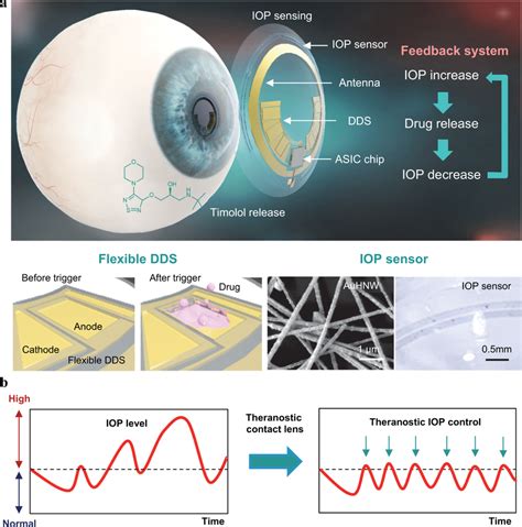 Schematic Illustration Of A Theranostic Smart Contact Lens For Glaucoma Download Scientific