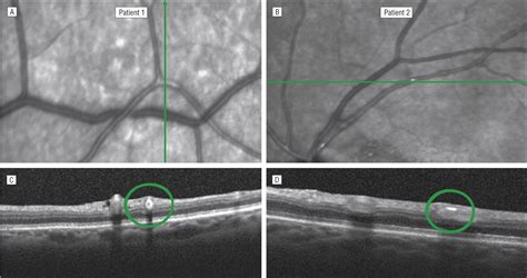 Visualization Of Retinal Emboli With High Resolution Optical Coherence