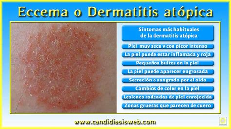 Síntomas de la candidiasis Eccema o Dermatitis atópica