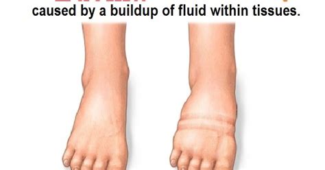 Pitting Edema Levels