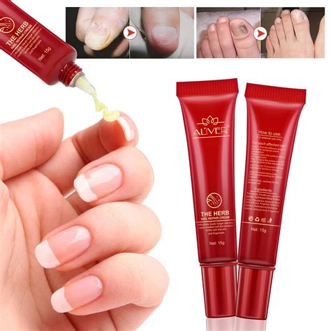 Aliexpress.com : Buy Good Result Toe Nail Fungus Treatment Cream ...