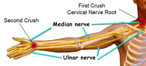 Emg Best Test To Diagnose Cubital Tunnel Neuro Testing Group Expert