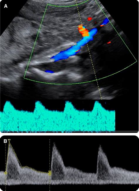 Doppler Assessment Of The Fetus With Intrauterine Growth Restriction