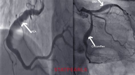 Coronary Ectasia Statpearls Ncbi Bookshelf