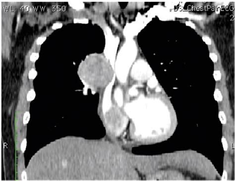 Figure 1 From Superior Vena Cava Syndrome Due To Isolated