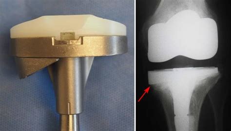 Revision Total Knee Replacement Orthoinfo Aaos