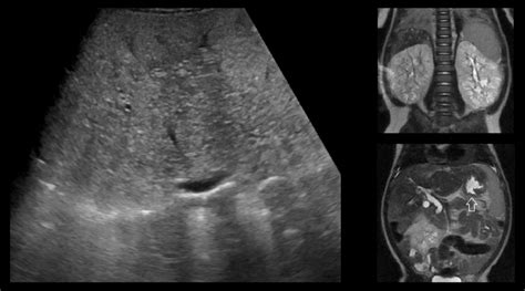 Ultrasound image showing coarse parenchymal texture and selected... | Download Scientific Diagram