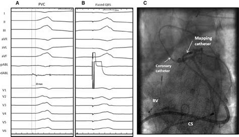 Figure From Surgical Mapping And Ablation In The Left Ventricular