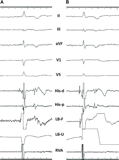 Septal Perforation During Left Bundle Branch Pacing With Lumenless