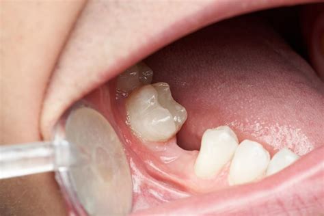 Dental Options For Missing Teeth At Sandra Hartung Blog