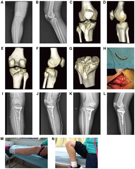 Anterior Tibial Plateau Fracture