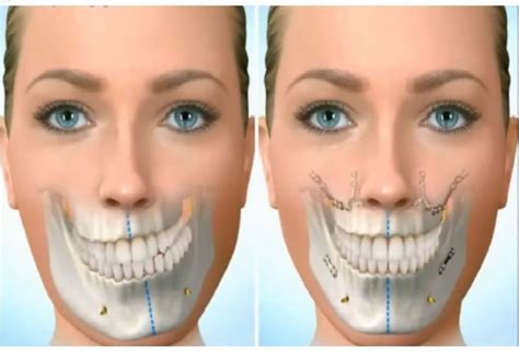 Qué Procedimientos realiza un Cirujano Oral y Maxilofacial