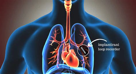 Implantable loop recorder | Pulse Cardiology Center