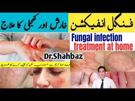 Fungal Infection Cream Formula Cream Side Effects Treatment Kharish